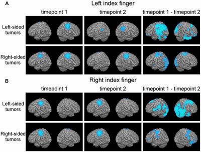 Motor Cortical Network Plasticity in Patients With Recurrent Brain Tumors